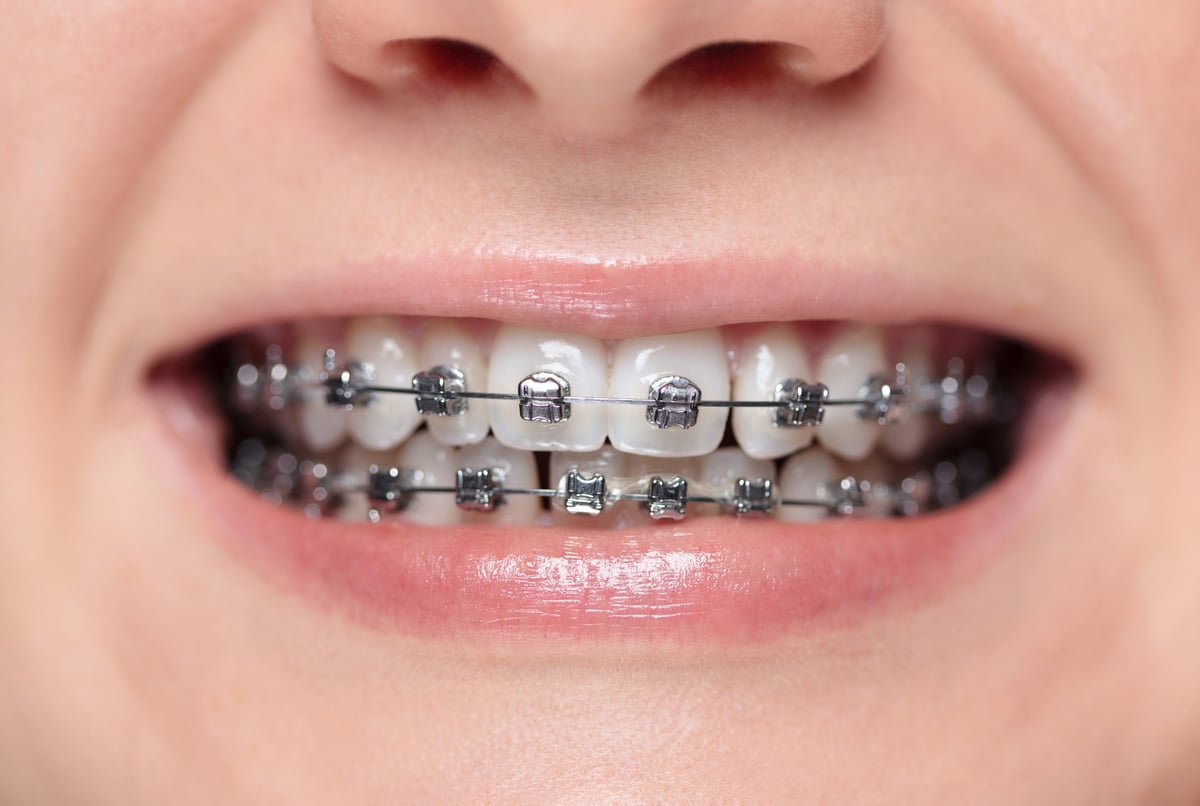 Woman with braces on her teeth is smiling. Metal bracket system on the teeth of a young woman. Shallow depth of field