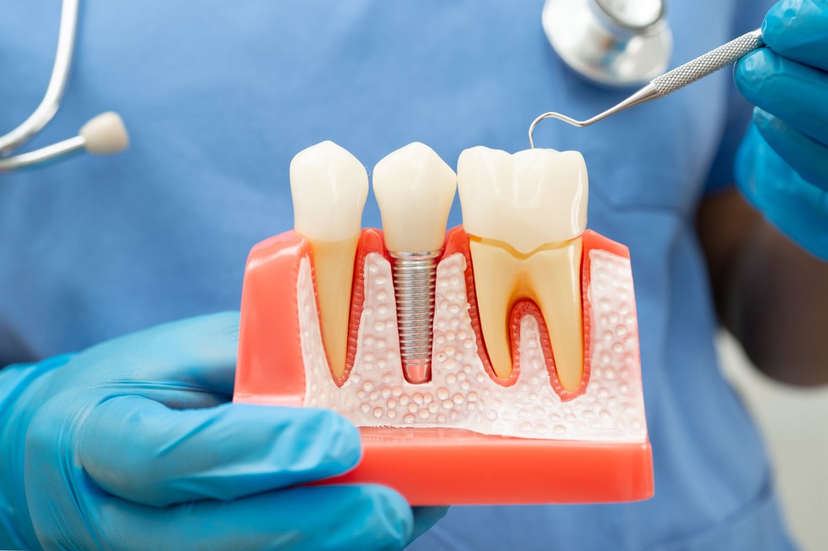 Dentist holding dental implant, artificial tooth roots into jaw