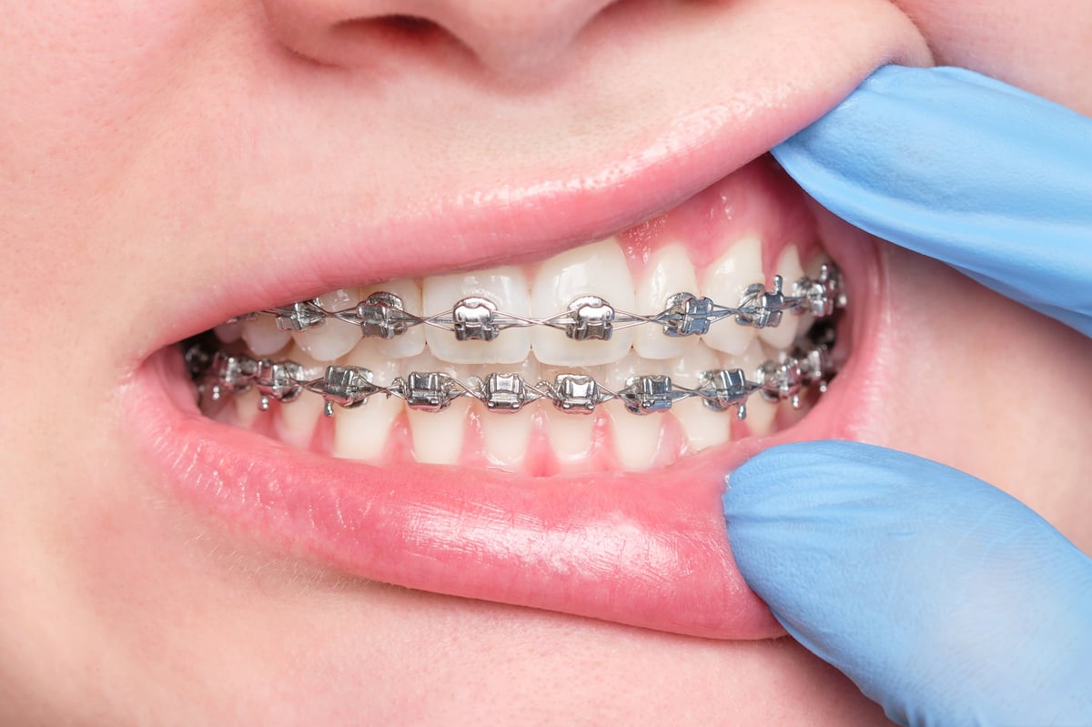 Close-up of a dentist's gloved hand opening the mouth of a patient with metal bracket system on the teeth of a young woman
