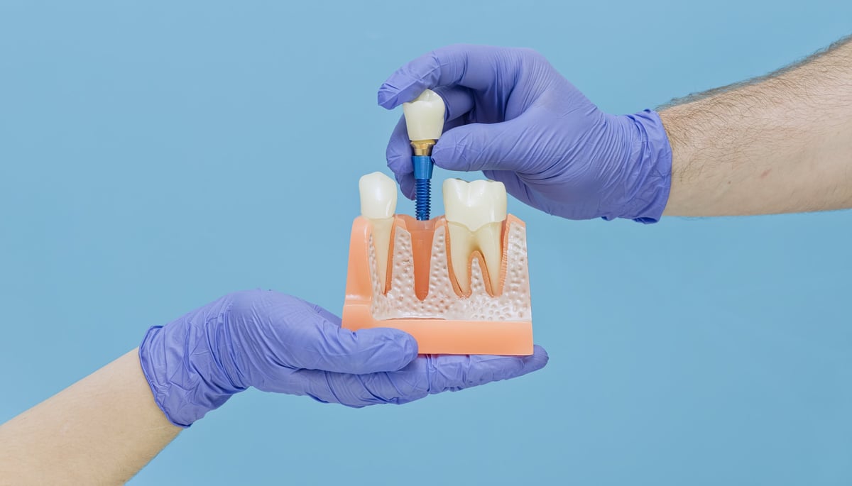 Dental surgery concept: Placing a titanium implant with crown into an artificial jaw.