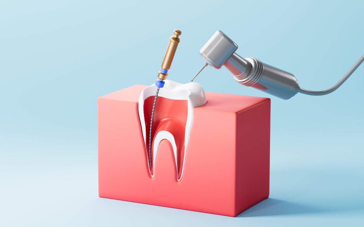 Human teeth root canal treatment process. 3d rendering. 3d illustration.