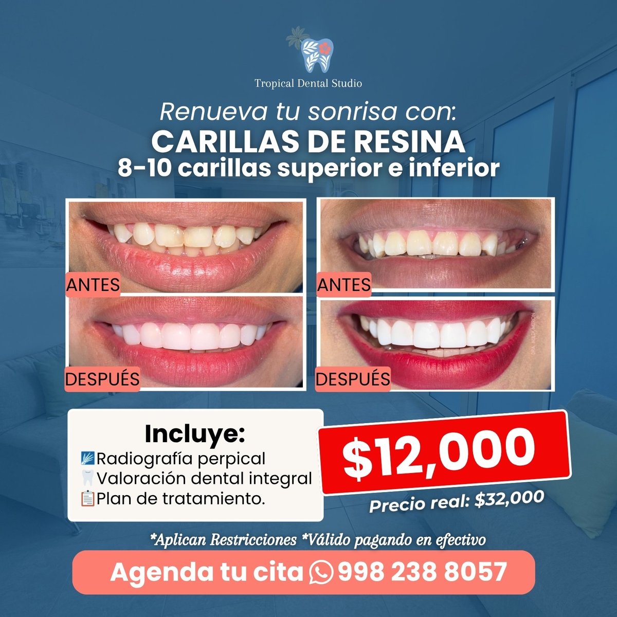 Carillas de resina $12,000